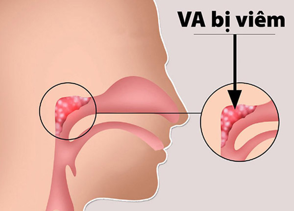 Cách điều trị hiệu quả bệnh viêm VA mãn tính
