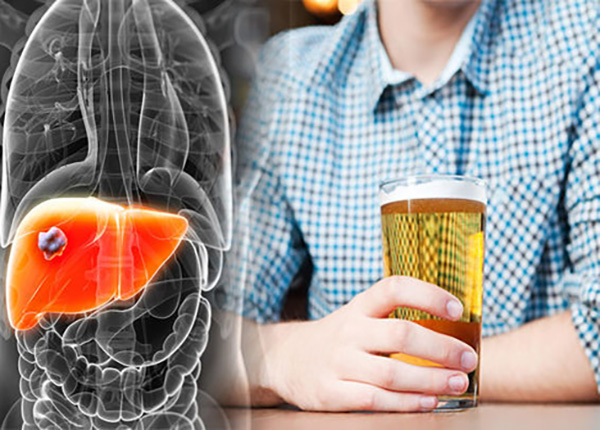 Những tác hại của bia rượu đối với người bệnh mãn tính