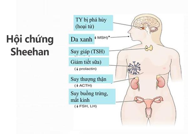 Bác sĩ Trường Cao đẳng Dược Sài Gòn chia sẻ về hội chứng Sheehan