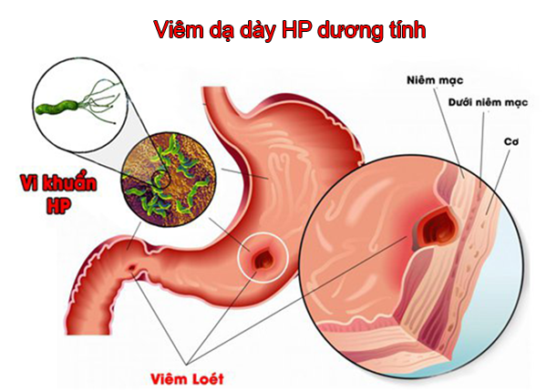 Bác sĩ Trường Dược Sài Gòn chia sẻ bệnh viêm dạ dày HP dương tính