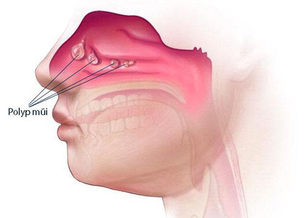 Bệnh Polyp mũi và những vấn đề cần lưu ý từ bác sĩ Trường Dược SG