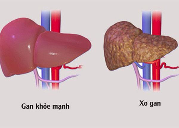 Các biện pháp giúp phòng ngừa xơ gan do rượu hiệu quả