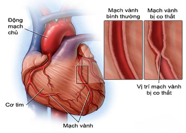 Các kiểu đau thắt ngực cảnh báo bệnh động mạch vành