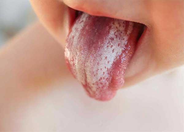 Điều dưỡng Sài Gòn chia sẻ dấu hiệu nhận biết bệnh nấm miệng