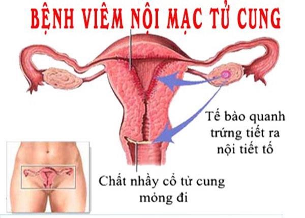 Điều trị bệnh viêm nội mạc tử cung mãn tính với chuyên gia Dược Sài Gòn