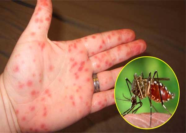 Dược sĩ Sài Gòn cảnh báo sự nguy hiểm của bệnh sốt xuất huyết Dengue
