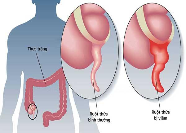 Dược sĩ Sài Gòn chia sẻ nguyên nhân và những dấu hiệu của viêm ruột thừa