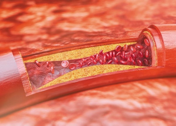 Dấu hiệu nhận biết kháng insulin qua da và khuôn mặt