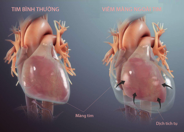 Lưu ý về bệnh viêm màng ngoài tim từ B.s Trường Dược Sài Gòn