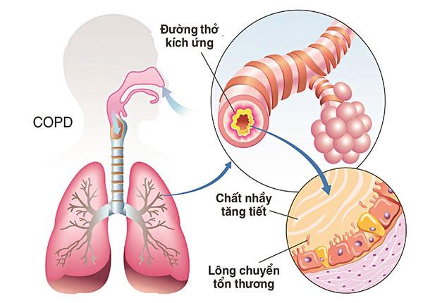 Nguyên nhân, triệu chứng và cách điều trị bệnh phổi tắc nghẽn mãn tính