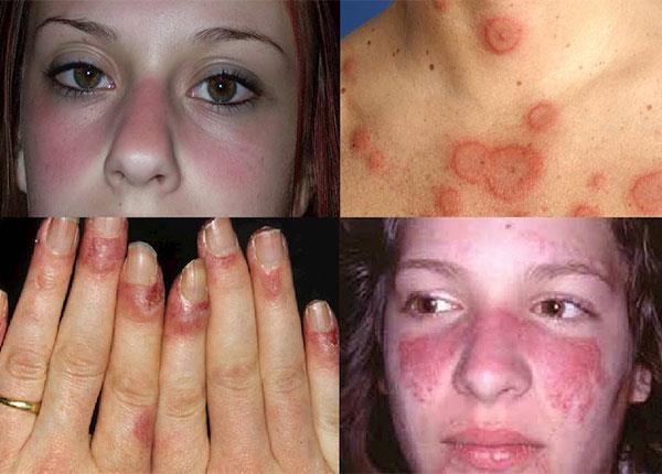 Nguyên nhân và triệu chứng thường gặp của bệnh Lupus ban đỏ