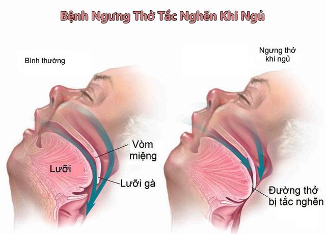Những dấu hiệu nhận biết và điều trị bệnh ngưng thở tắc nghẽn khi ngủ