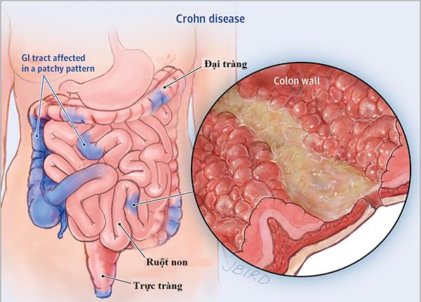 Những điều bạn cần biết về bệnh viêm ruột crohn
