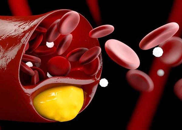 Những lưu ý về bệnh tăng cholesterol máu gia đình từ bác sĩ Trường Dược Sài Gòn