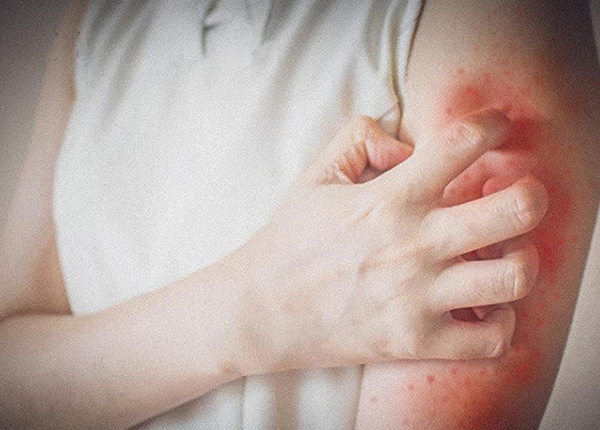 Phát ban không sốt ở người lớn là biểu hiện của những bệnh gì?