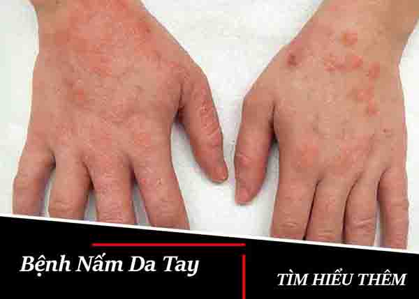 Tìm hiểu về bệnh nấm da tay từ B.s Trường Dược Sài Gòn