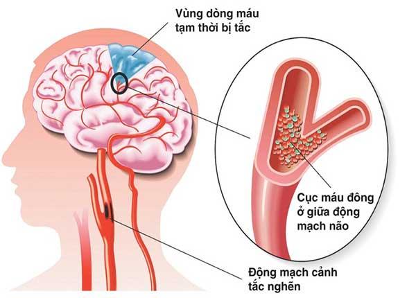 Tìm hiểu căn bệnh nhồi máu não với bác sĩ Trường Dược Sài Gòn