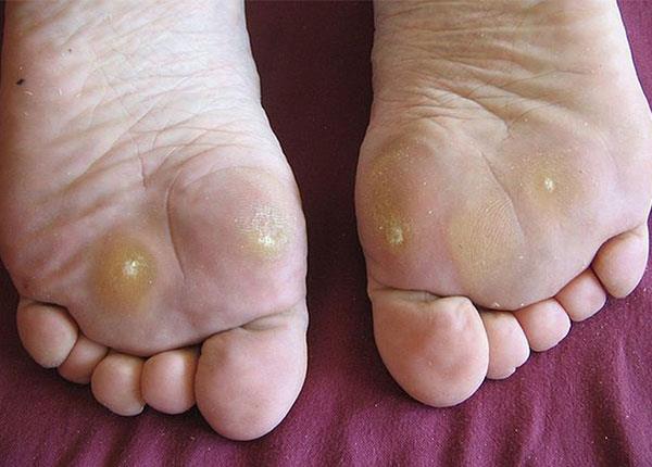 Trị bệnh chai chân đơn giản nhờ bài thuốc y học cổ truyền