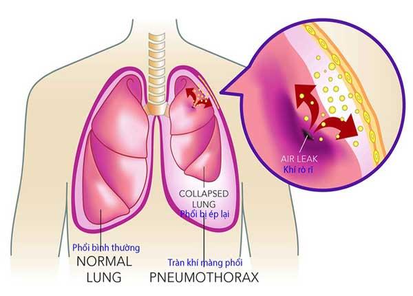 Triệu chứng và phương pháp điều trị bệnh tràn khí màng phổi