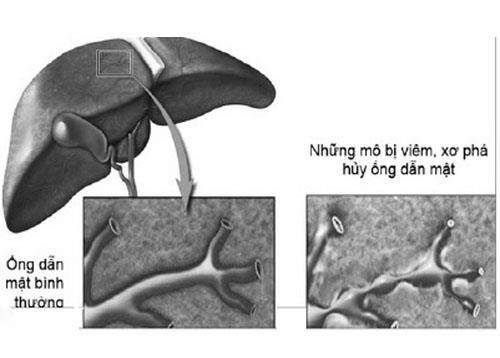 Bác sĩ giảng viên Trường Dược Sài Gòn chia sẻ về bệnh viêm xơ đường mật