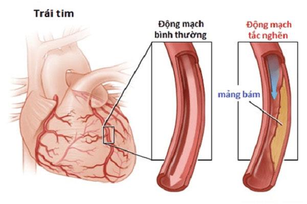 Bác sĩ Trường Dược Sài Gòn cảnh báo mối nguy hiểm của bệnh động mạch vành