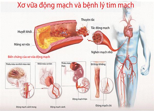 Bác sĩ Trường Dược Sài Gòn chia sẻ về bệnh xơ vữa động mạch