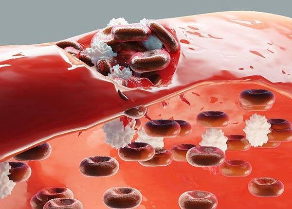 Bệnh máu khó đông là gì và cách điều trị ra sao?