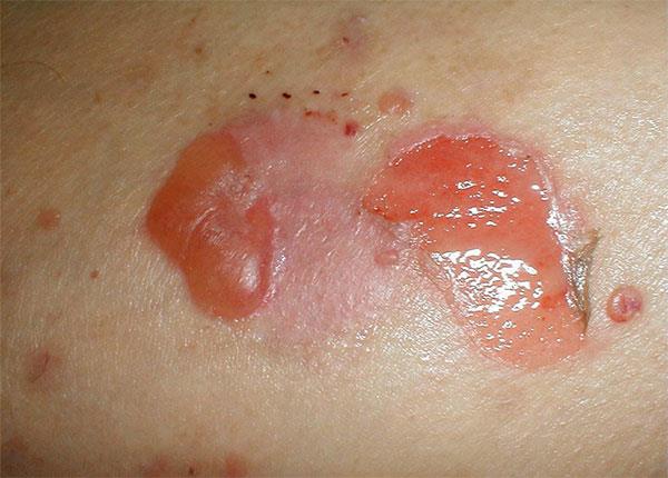 Các giai đoạn phát triển của bệnh viêm da tiếp xúc dị ứng bội nhiễm