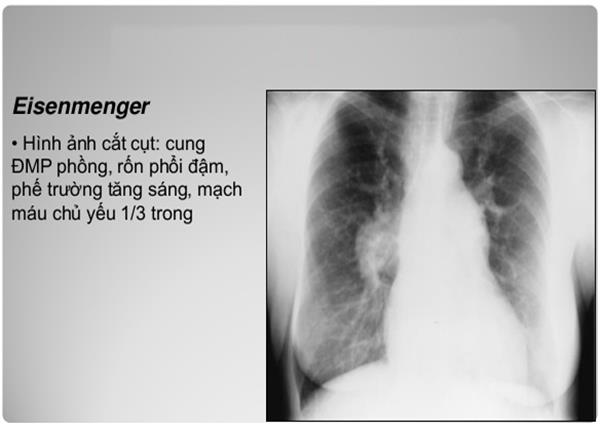 Cùng bác sĩ Trường Dược Sài Gòn tìm hiểu hội chứng Eisenmenger