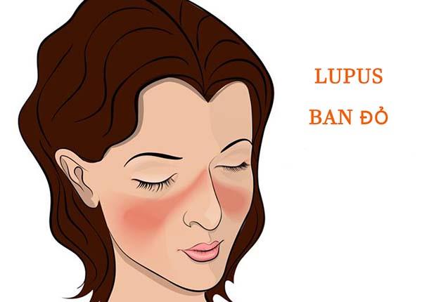 Cùng B.s Trường Dược Sài Gòn tìm hiểu về bệnh lupus ban đỏ