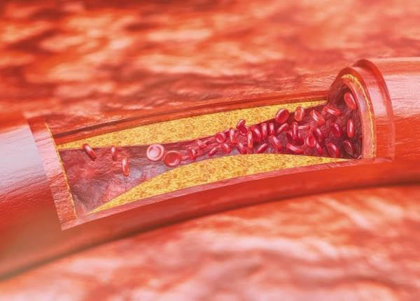 Dấu hiệu nhận biết kháng insulin qua da và khuôn mặt
