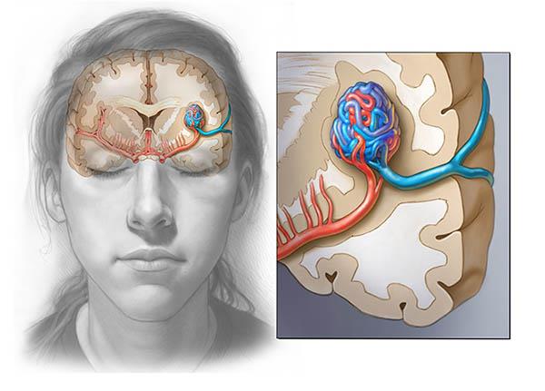 Dị dạng mạch máu não nguy cơ tiềm ẩn dẫn đến xuất huyết não