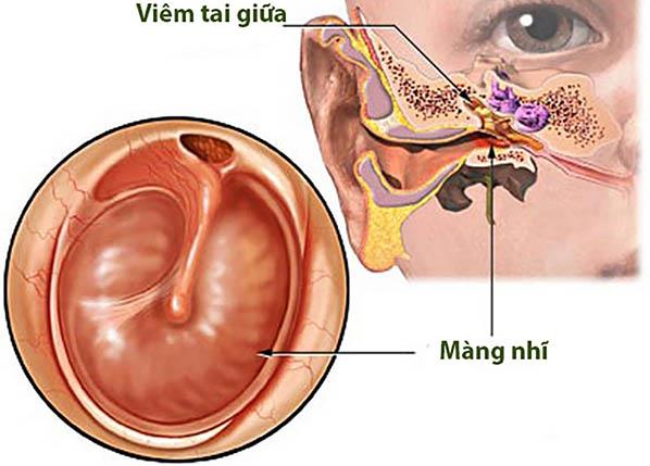 Lưu ý về bệnh viêm tai giữa có mủ từ B.s Trường Dược Sài Gòn