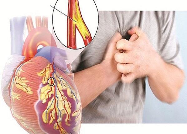Nguyên nhân và hướng điều trị bệnh xơ vữa động mạch