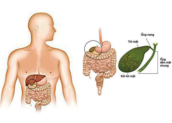 Nguyên nhân và triệu chứng thường gặp của bệnh ung thư đường mật