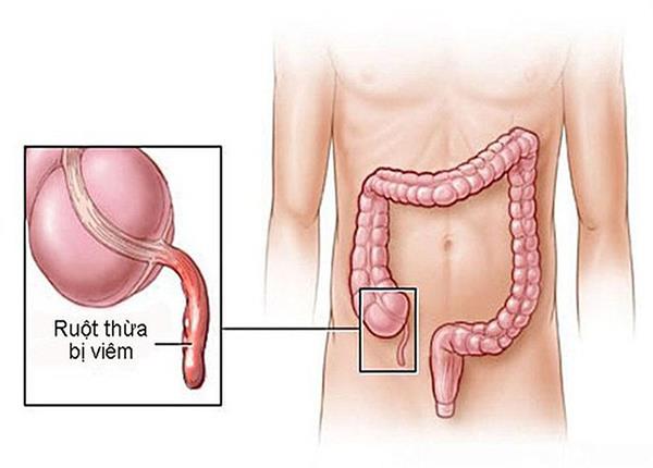 Những chia sẻ về bệnh viêm ruột thừa từ B.s Trường Dược Sài Gòn