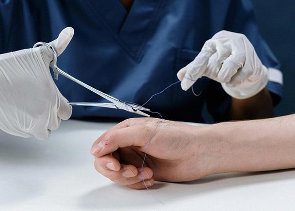 Những lưu ý quan trọng về thời gian cắt chỉ vết khâu