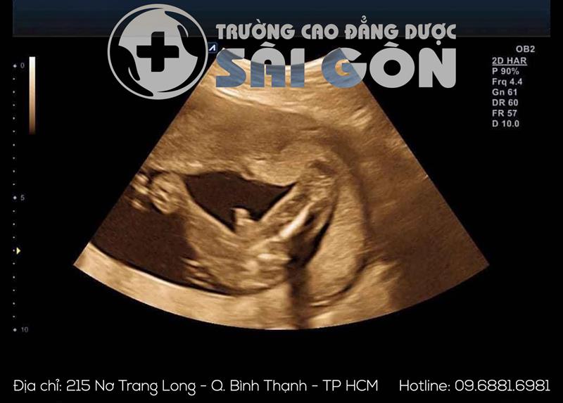 Thai phụ có nên siêu âm thai trong ba tháng đầu thai kỳ không?