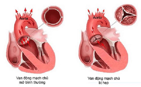 Tìm hiểu bệnh hẹp van động mạch chủ với các bác sĩ Trường Dược SG