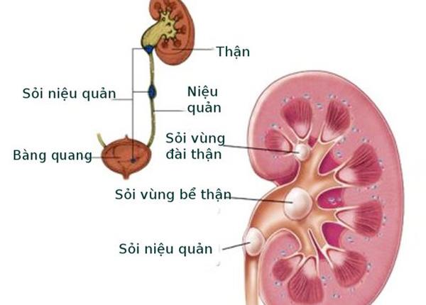 Tìm hiểu bệnh sỏi niệu quản từ B.s Trường Dược Sài Gòn